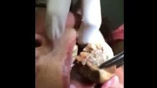 Tartar Removal [upl. by Arok]