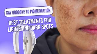 Dark Spots On Face Removal  Best Treatments [upl. by Jarib987]