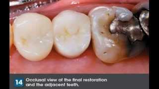 How to Adjust and Polish FullContour Zirconia Crowns [upl. by Doane]