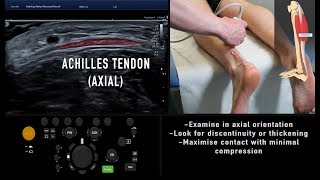 Ultrasound Tutorial MSK Series Achilles Tendon  Radiology Nation [upl. by Damaris]