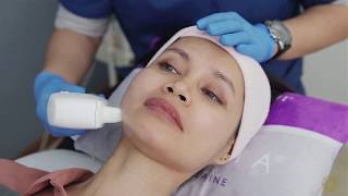 What is HIFU treatment  Instant Facelift without surgery [upl. by Ailecara]