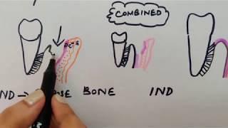 Periodontal flap part 1 carranza chap57 [upl. by Anirehtak]