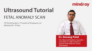 Fetal Anomaly scan by Dr Devang Patel on Mindray DC70 Expert Ultrasound System [upl. by Ayalat]