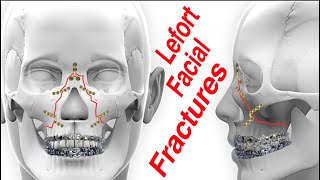 Lefort 13 Upper Jaw MidFace Facial Fractures [upl. by Samanthia]