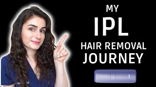 My IPL hair removal journey  Ulike IPL at home [upl. by Ayatnwahs825]