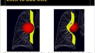 Mediastinal masses approach [upl. by Manuel]