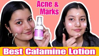 I USED THIS CALAMINE LOTION FOR 7 YEARS For My Pimples amp Marks [upl. by Amann]