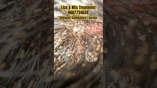 lice removalhow to remove lice from hairlicelice nits treatment now in Coimbatore Chennai Kerala [upl. by Kenweigh]