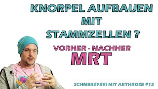 Stammzellen Knorpel aufbauen Stammzelltherapie Vorher  Nachher MRT Schmerzfrei mit Arthrose 12 [upl. by Eelrahc]