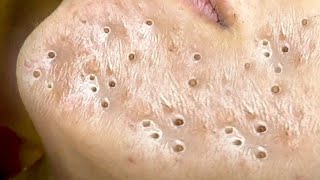 Big Cystic Acne Blackheads Extraction Blackheads amp Milia Whiteheads Removal Pimple Popping  8387 [upl. by Ecirtel81]