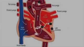 What is hypoplastic left heart syndrome HLHS [upl. by Wells]