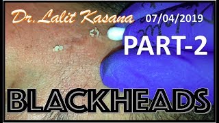 BLACKHEAD REMOVAL WITH COTTON BUDS AND EXTRACTOR PART 2 by DrLalit Kasana [upl. by Schaper]