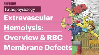 Extravascular Hemolysis amp RBC Defects Pathophysiology Part 1  Sketchy Medical  USMLE Step 1 [upl. by Corotto]