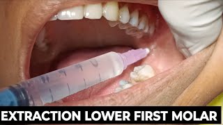 EXTRACTION LOWER FIRST MOLAR  LEFT SIDE LOWER FIRST MOLAR EXTRACTION  LOWER MOLAR EXTRACTION [upl. by Suilmann]