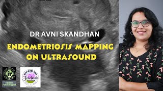 AVNI SKANDHAN  ENDOMETRIOSIS MAPPING by Ultrasound endometriosis [upl. by Britt356]