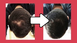 CALVITIE  Le MINOXIDIL contre la chute de cheveux Alostil 5 [upl. by Aihsekyw947]