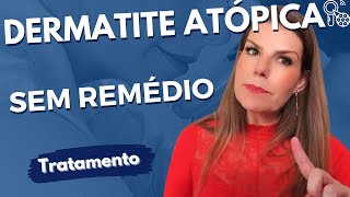 8 formas de tratar a dermatite atópica SEM REMÉDIO [upl. by Rosario]