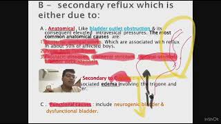 SurgeryVesicoureteric reflux disease [upl. by Ecallaw]