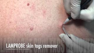 LAMPROBE Skin Tag Removing treatment [upl. by Gamal]