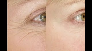 Best Face Yoga Exercise for Eye Wrinkles  FACEROBICS® [upl. by Aihsyla]