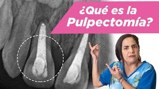 Pulpectomía ¿Qué es ¿Cuándo se debe hacer [upl. by Anniken]