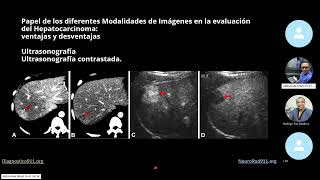 Cirrosis Imágenes en lesiones benignas y malignas [upl. by Massarelli]