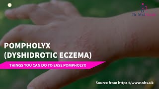 Pompholyx  Dyshidrotic eczema  dyshidrotic eczema treatment [upl. by Ddat]