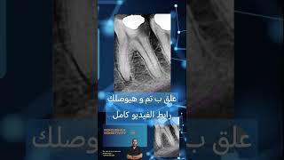 Clinical cases in Endodontics الكربولة endodontics dental [upl. by Rockafellow983]