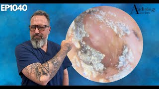 Removing Infected Ear Wax A Relief Like No Other  EP1040 [upl. by Ainocal808]