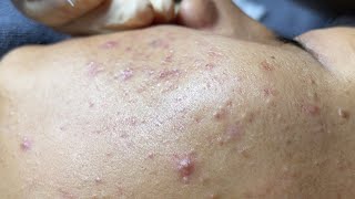 Blackheads amp Whiteheads Removal New 2024  Acne Treatment With Bo Nguyễn Spa 025 [upl. by Amlus]