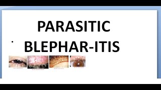 Ophthalmology 371 Parasitic Blepharitis Infestation Lice phthirus pediculosis yellow mercuric oxide [upl. by Araes588]