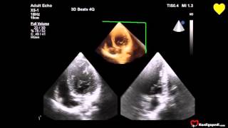 Romatizmal Mitral Yetersizliği ve Sol Ventrikül Disfonksiyonu [upl. by Silvan171]