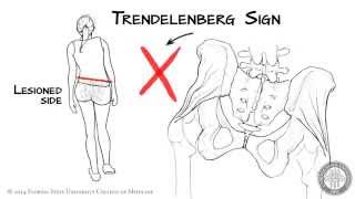 The Trendelenberg Sign HD [upl. by Liza663]