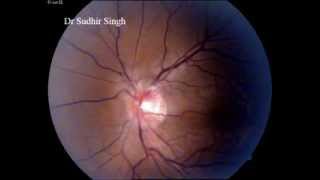 Central Retinal Vein Venous Pulsation On Optic Disc By Dr Sudhir Singh [upl. by Yelnoc]