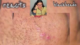 blackheads nose blackheads removal satisfying blackheads removal lips blackheads removal ear [upl. by Dunning]