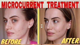 MICROCURRENT FACIAL BEFORE AND AFTER  NUOVALUCE MICROCURRENT REVIEW 2021  Madella Beauty [upl. by Dorkas]