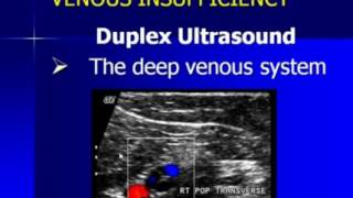 Lower Extremity Venous Duplex Ultrasound Chronic Venous Insufficiency [upl. by Penman]