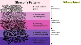 The Gleason Grading System For Prostate Cancer  Gleason Score [upl. by Eneleuqcaj]