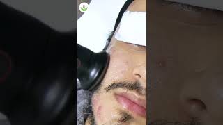 Acne Scar Removal Procedure for Flawless Skin at Care Well Medical Centre [upl. by Einotna]