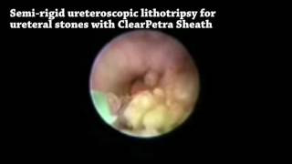 Litotricia con ureteroscopio semirígido para cálculos ureterales distales con vaina CLEARPETRA 2 [upl. by Banky]