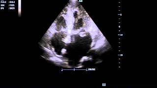 Mitral Valve Vegetation [upl. by Sharia521]