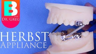 BRACES EXPLAINED Herbst Appliance [upl. by Izogn]