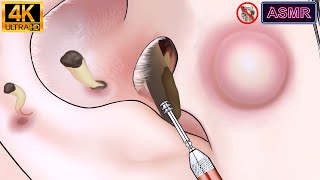 ASMR Cool feeling Blackheads sebaceous cyst squeeze Wax removal animation asmrquottinglequot [upl. by Cthrine]