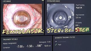 LASER Vision Correction Femto LASIK and PRK eye surgery for high myopia and astigmatism [upl. by Drusus205]