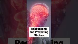 Recognizing and preventing strokes stroke strokesupport strokesymptoms health stroketreatment [upl. by Yajeet]