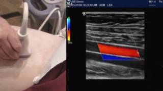 How To Lower Extremity Arterial Duplex Exam [upl. by Dnomal]