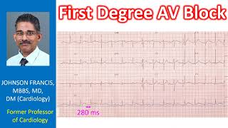 First Degree AV Block [upl. by Shena735]