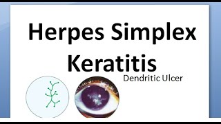 Ophthalmology 116 Herpes Simplex Keratitis Virus Cornea Dendritic HSV Wessley NeuroTrophic Disciform [upl. by Athal183]