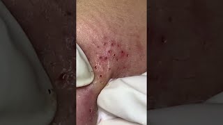 Big Cystic Acne Blackheads Extraction Blackheads amp Milia Whiteheads Removal Pimple Popping shorts [upl. by Eldrida]