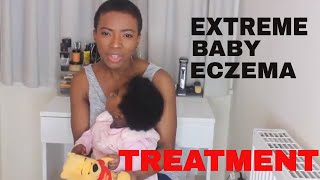 EXTREME BABY ECZEMA TREATMENT [upl. by Assenov]